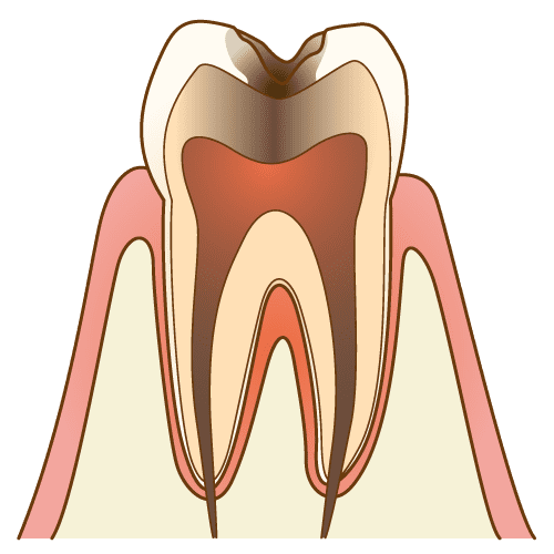 C3（歯髄まで及んだ虫歯）