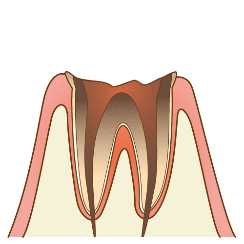 C4（歯根だけ残った虫歯）