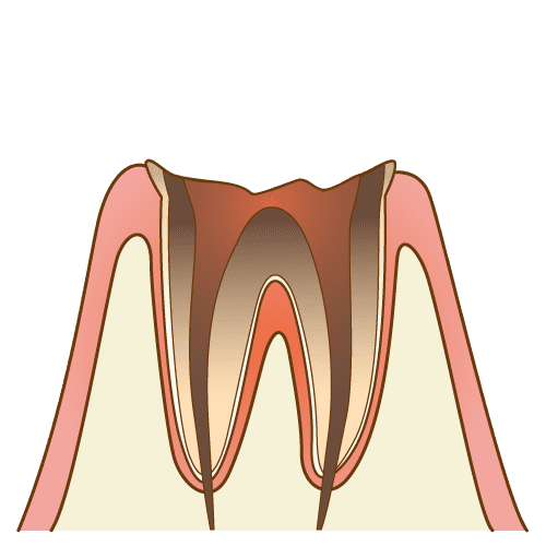 C4(歯根だけ残った虫歯)