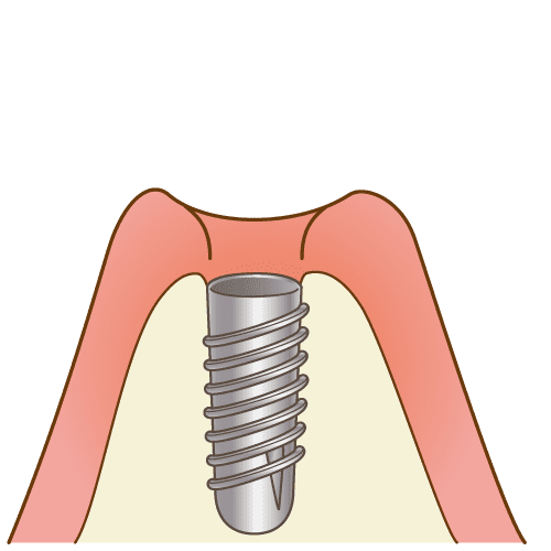 ④ インプラント一次手術(60分～90分)