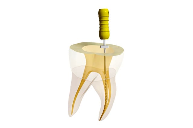歯の神経治療「根管治療」
