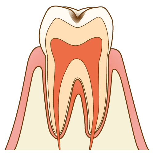 C1（エナメル質虫歯）