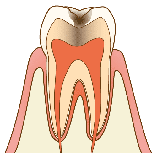 C2（象牙質虫歯）
